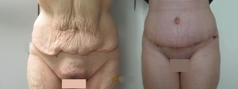 Reconstruction after massive weight loss