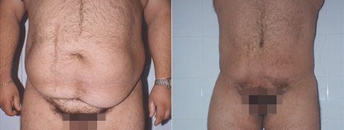 Reconstruction after massive weight loss