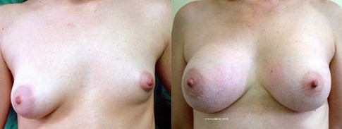 Breast Asymmetry