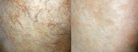 Spider veins removal